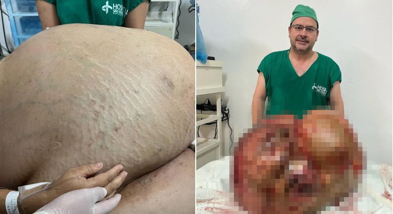 Tumor com cerca de 46 kg é retirado de mulher em cirurgia de emergência no RJ￼