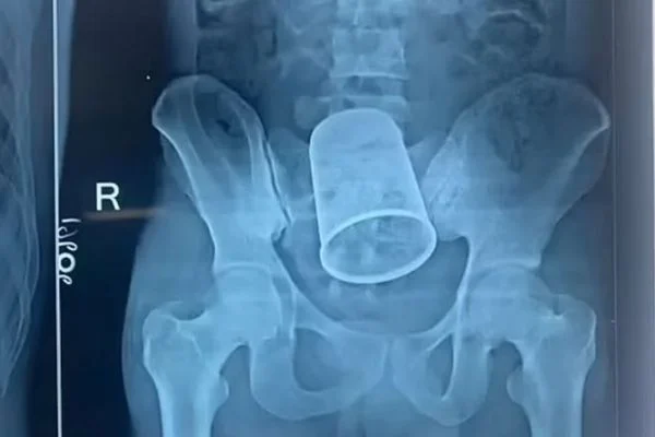 Durante bebedeira, jovem introduz copo de metal pelo ânus e vai parar no hospital￼￼