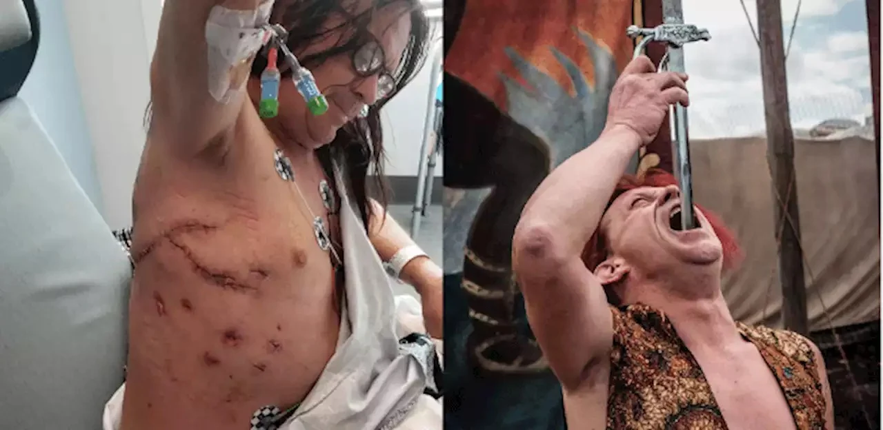 Engolidor de espadas fica em coma e perde 22 kg após desafio com 5 lâminas