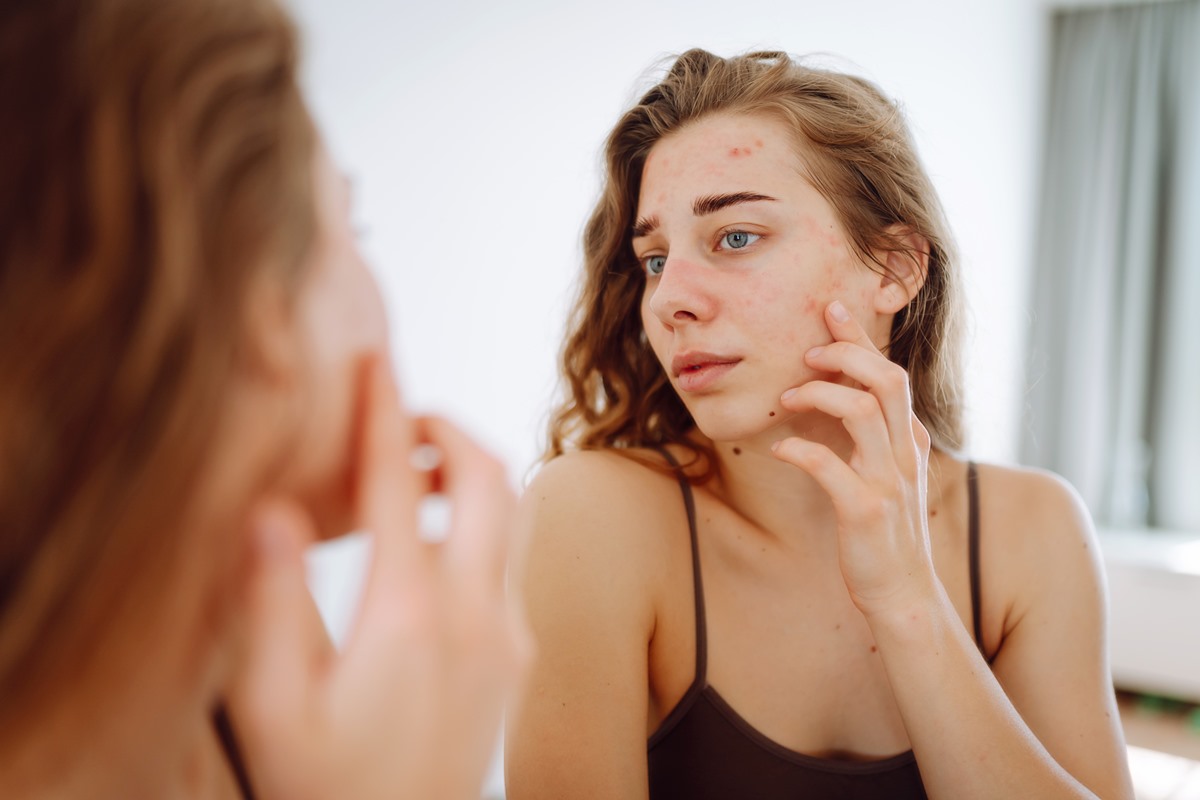 Dermatologistas revelam qual método contraceptivo pode piorar a acne